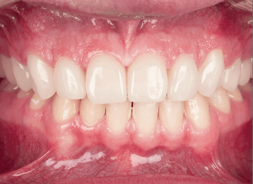 Full Crowns — dettaglio del restauro