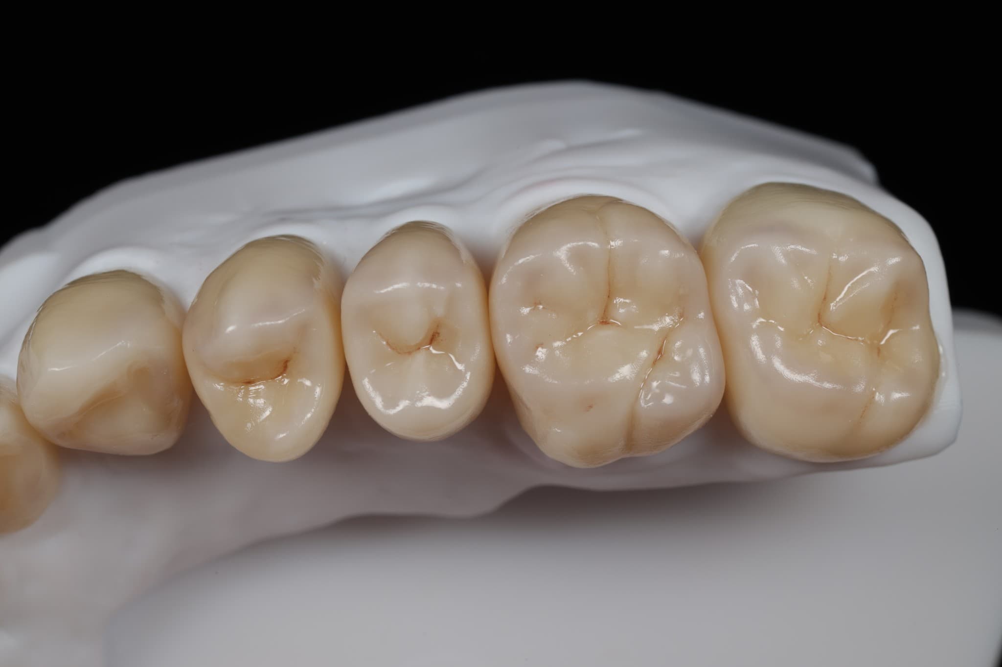 Vonley Crowns — corone in zirconia su modello