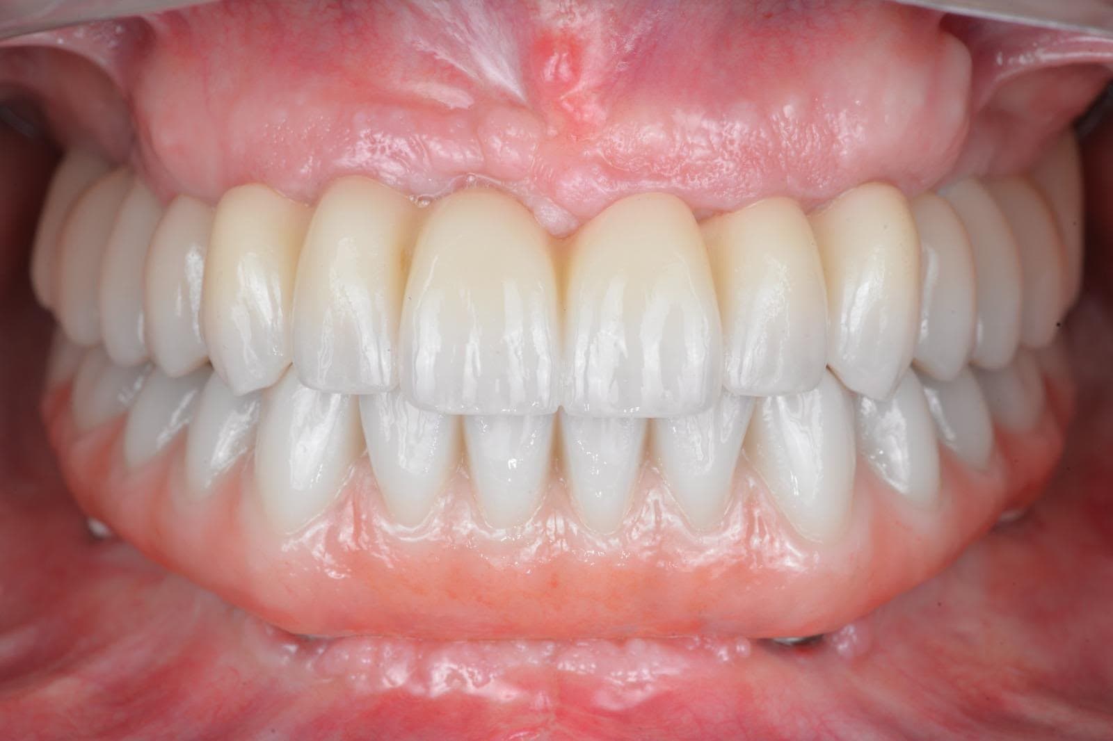 Zirconia su Zirconia — riabilitazione fissa su impianti in zirconia